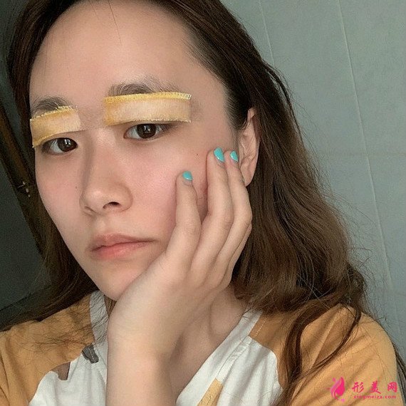 全切雙眼皮恢復(fù)的速度很快，就算是素顏也很美！