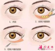 手術(shù)切除眼袋會(huì)失敗嗎？