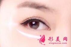 手術(shù)切除眼袋會(huì)失敗嗎