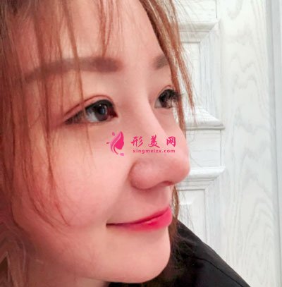 北京美萊醫(yī)療美容醫(yī)院鼻部多項(xiàng)手術(shù)案例