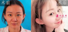 北京美萊整形美容醫(yī)院做鼻部多項(xiàng)效果如何？隆鼻案例術(shù)后100天分