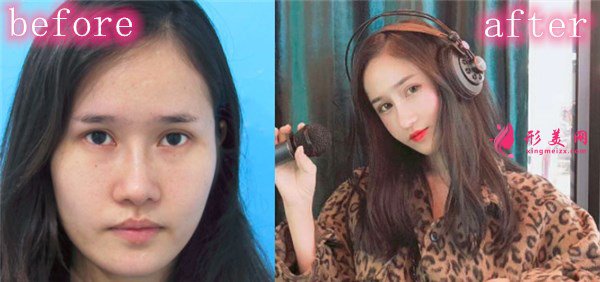 深圳麗港麗格醫(yī)療美容肋軟骨隆鼻