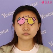 鼻頭圓扁肥大到堅(jiān)挺精致之間只隔個(gè)溫州藝星整形醫(yī)院