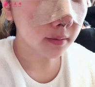 寧波壹加壹整形醫(yī)院，郭光燁醫(yī)生鼻整形案例分享