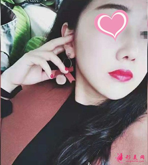 寧波郭光燁隆鼻多久能恢復