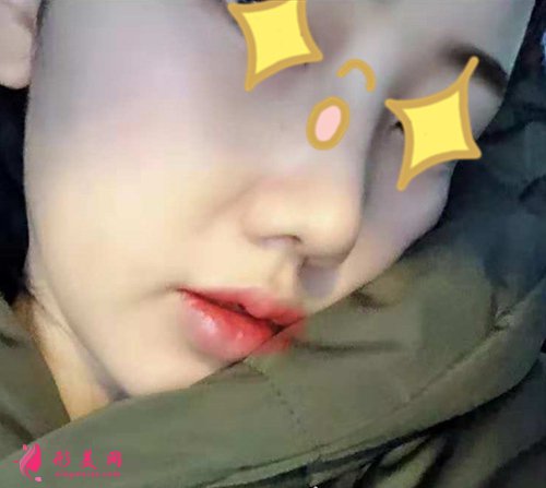 寧波壹加壹整形隆鼻真實案例