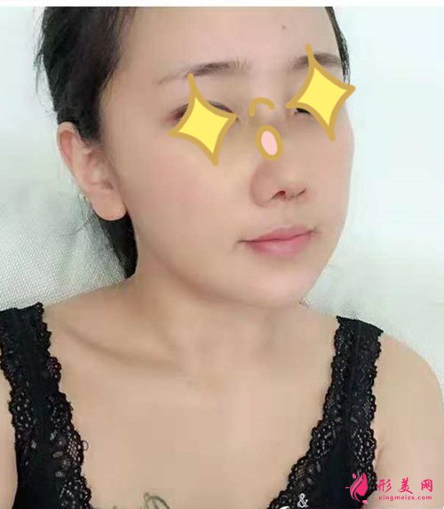 寧波假體隆鼻術后一周實拍