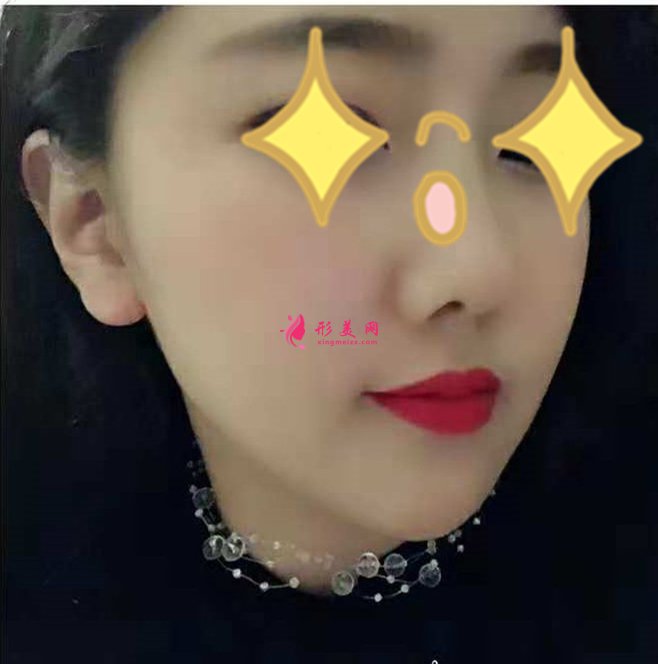 寧波郭光燁蒙特鼻效果好不好
