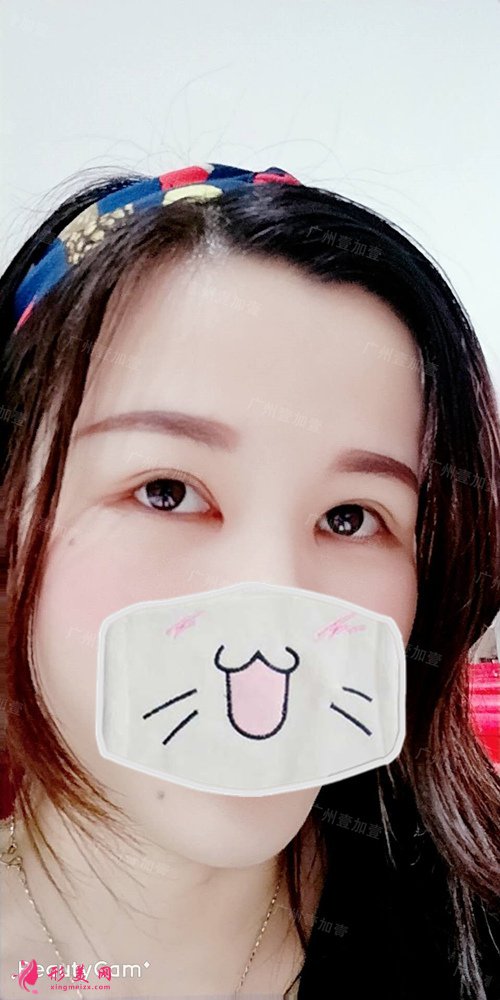 雙眼皮開眼角術(shù)后40天