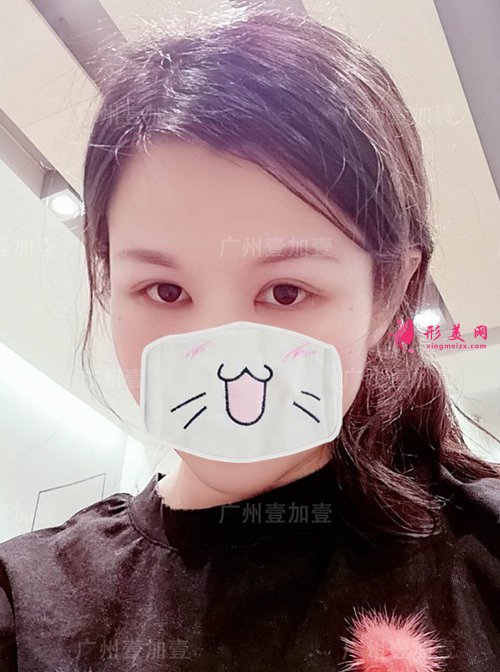 雙眼皮術(shù)后15天
