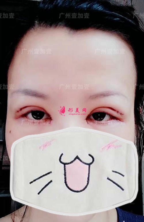 雙眼皮術(shù)后第二天