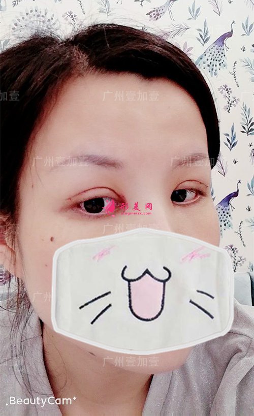 雙眼皮開眼角術(shù)后一周