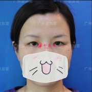 廣州壹加壹整形醫(yī)院雙眼皮+開內(nèi)眼角手術(shù)案列分享