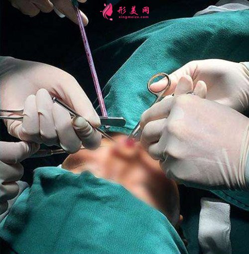 鼻綜合手術(shù)正在進(jìn)行