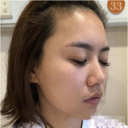 杭州華山連天美高俊明磨顴骨整形恢復(fù)日記