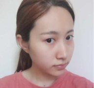 鄭州集美整形劉德輝做的雙眼皮效果圖來(lái)辣