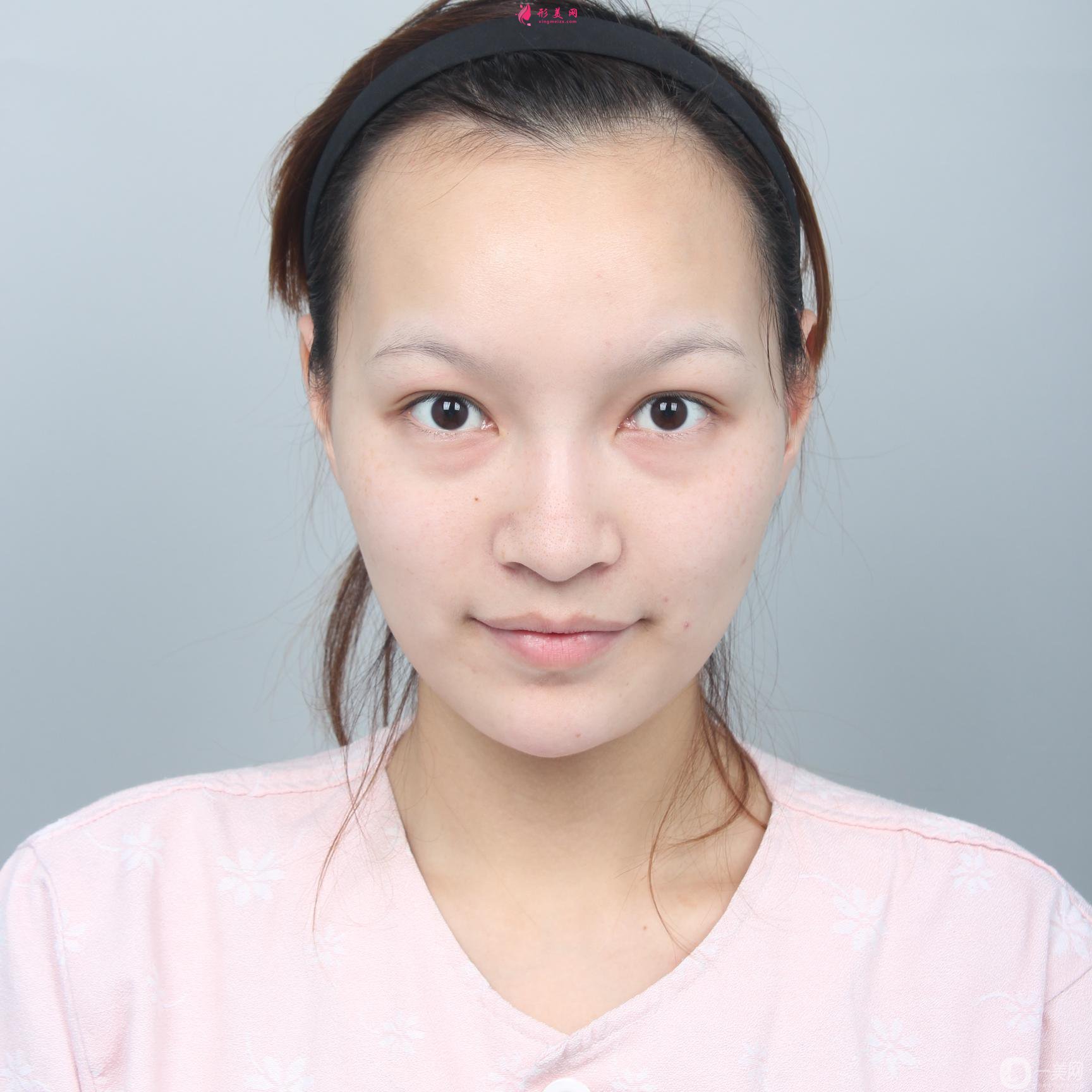 上海美聯(lián)臣下頜角整形恢復(fù)日記分享：術(shù)后500天了依然很完美~