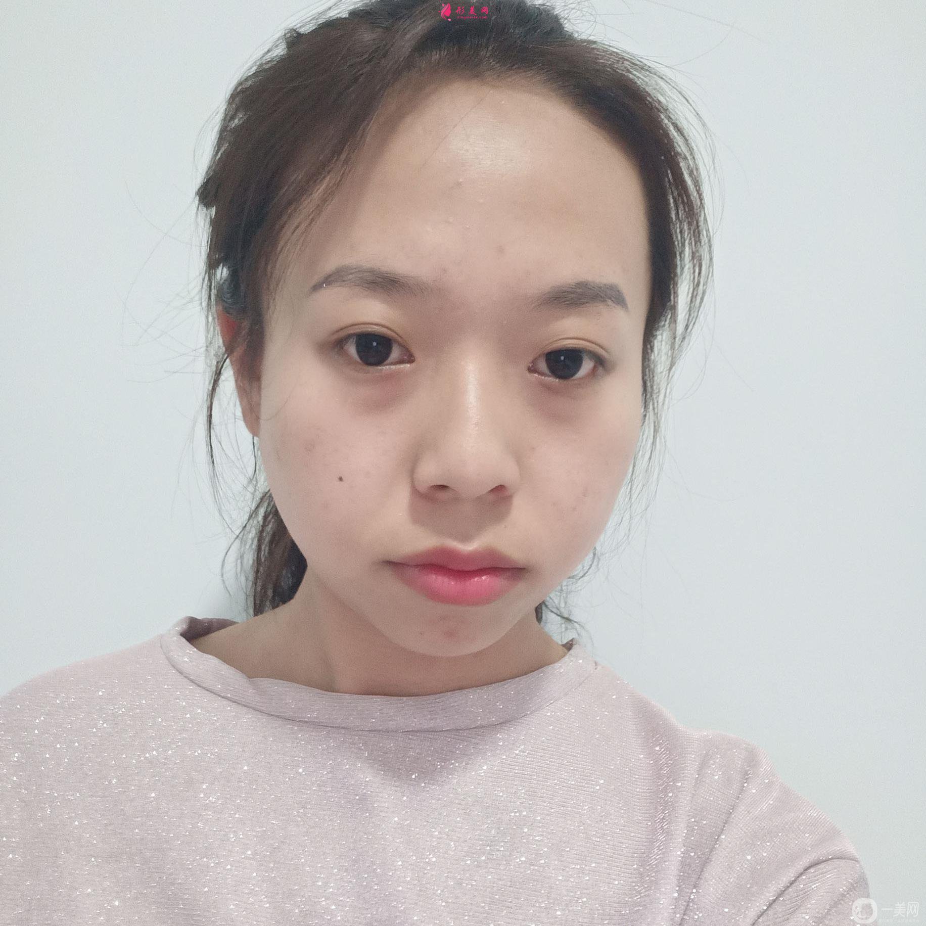自體脂肪面部填充才一個(gè)月就讓我找回了自信！