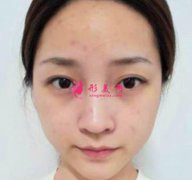 上海九院李青峰做鼻子怎么樣預(yù)約？案例手術(shù)風(fēng)格盡顯！