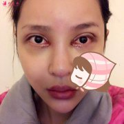 杭州瑞麗韓德昌醫(yī)生眼綜合整形怎么樣？分享我的心路歷程~