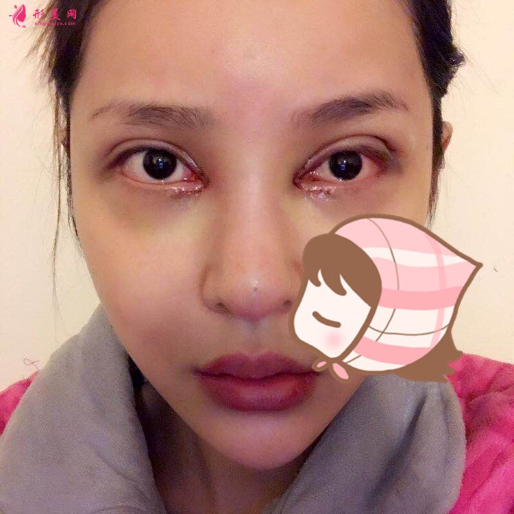 杭州瑞麗整形醫(yī)院韓德昌醫(yī)生眼綜合案例