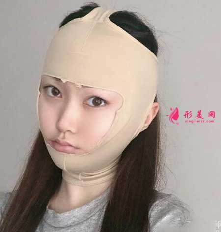 北大人民醫(yī)院彭喆醫(yī)生為我做下頜角整形,術(shù)后80天恢復(fù)效果