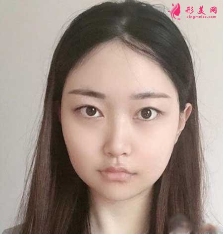 北大人民醫(yī)院彭喆醫(yī)生為我做下頜角整形,術(shù)后80天恢復(fù)效果
