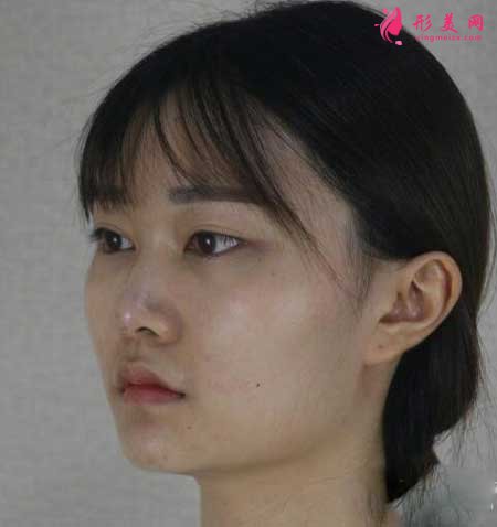 北大人民醫(yī)院彭喆醫(yī)生為我做下頜角整形,術(shù)后80天恢復(fù)效果