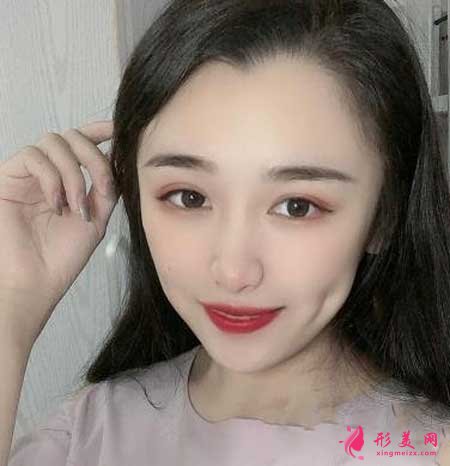 找南京鼓樓醫(yī)院譚謙醫(yī)生做了雙眼皮,我也是小仙女啦~