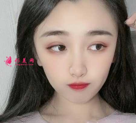 找南京鼓樓醫(yī)院譚謙醫(yī)生做了雙眼皮,我也是小仙女啦~