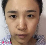 南京鼓樓醫(yī)院譚謙醫(yī)生做了雙眼皮,我也是小仙女啦~
