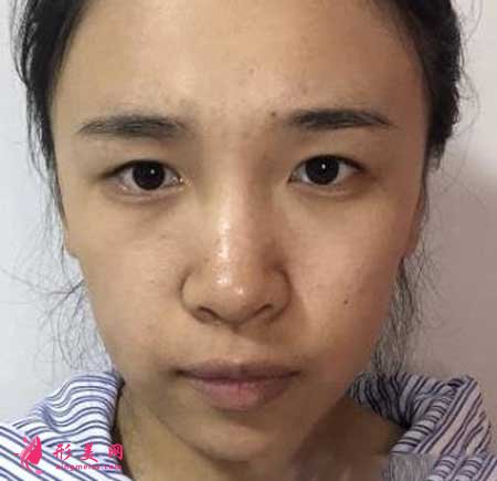 找南京鼓樓醫(yī)院譚謙醫(yī)生做了雙眼皮,我也是小仙女啦~