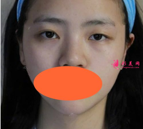 西安西京劉超華做雙眼皮怎么樣？40天恢復(fù)效果真的很棒