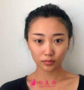 北京沃爾劉彥軍隆鼻怎么樣？案例兩個(gè)月效果展示