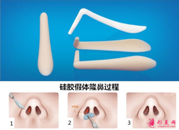 假體隆鼻術(shù)后還要更換嗎