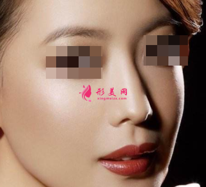 自體軟骨隆鼻后還能取出嗎