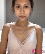 重慶一附院整形科真人隆胸案例，術(shù)后恢復過程圖分享