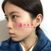 西安西京醫(yī)院整形科隆鼻怎么樣？案例證實醫(yī)生技術(shù)和手術(shù)風格！