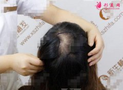 北京新生植發(fā)醫(yī)院頭頂加密植發(fā)8個(gè)月效果圖,前后對比圖分享