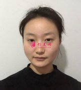 重慶時(shí)光整形美容醫(yī)院削骨術(shù)后效果對比圖分享