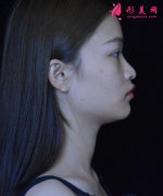 北京沃爾整形美容醫(yī)院磨骨術(shù)后效果，這款小V臉是你喜歡的嗎？