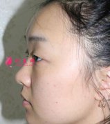 四川友誼整形美容醫(yī)院隆鼻怎么樣？術(shù)后效果對比