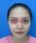深圳北大醫(yī)院整形外科去眼袋怎么樣？