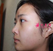 北京純脂面部吸脂效果理想，一起來看下案列分享！
