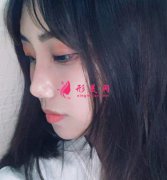 南昌二附院整形美容科割雙眼皮怎么樣？效果對(duì)比圖曝光