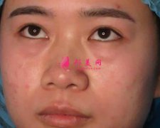 重慶藝星整形祛眼袋怎么樣?術(shù)后效果分享
