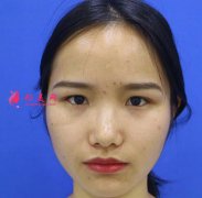 廈門安黛美整形美容雙眼皮怎么樣？術(shù)后三個(gè)月對(duì)比看效果