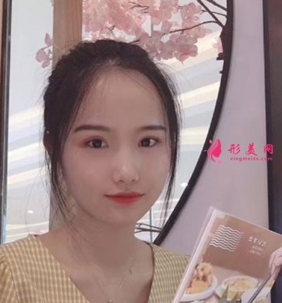 廈門安黛美醫(yī)療整形美容切開雙眼皮案例