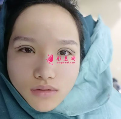 廈門安黛美醫(yī)療整形美容切開雙眼皮案例