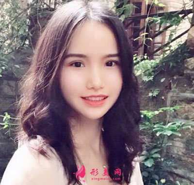廈門安黛美醫(yī)療整形美容切開雙眼皮案例